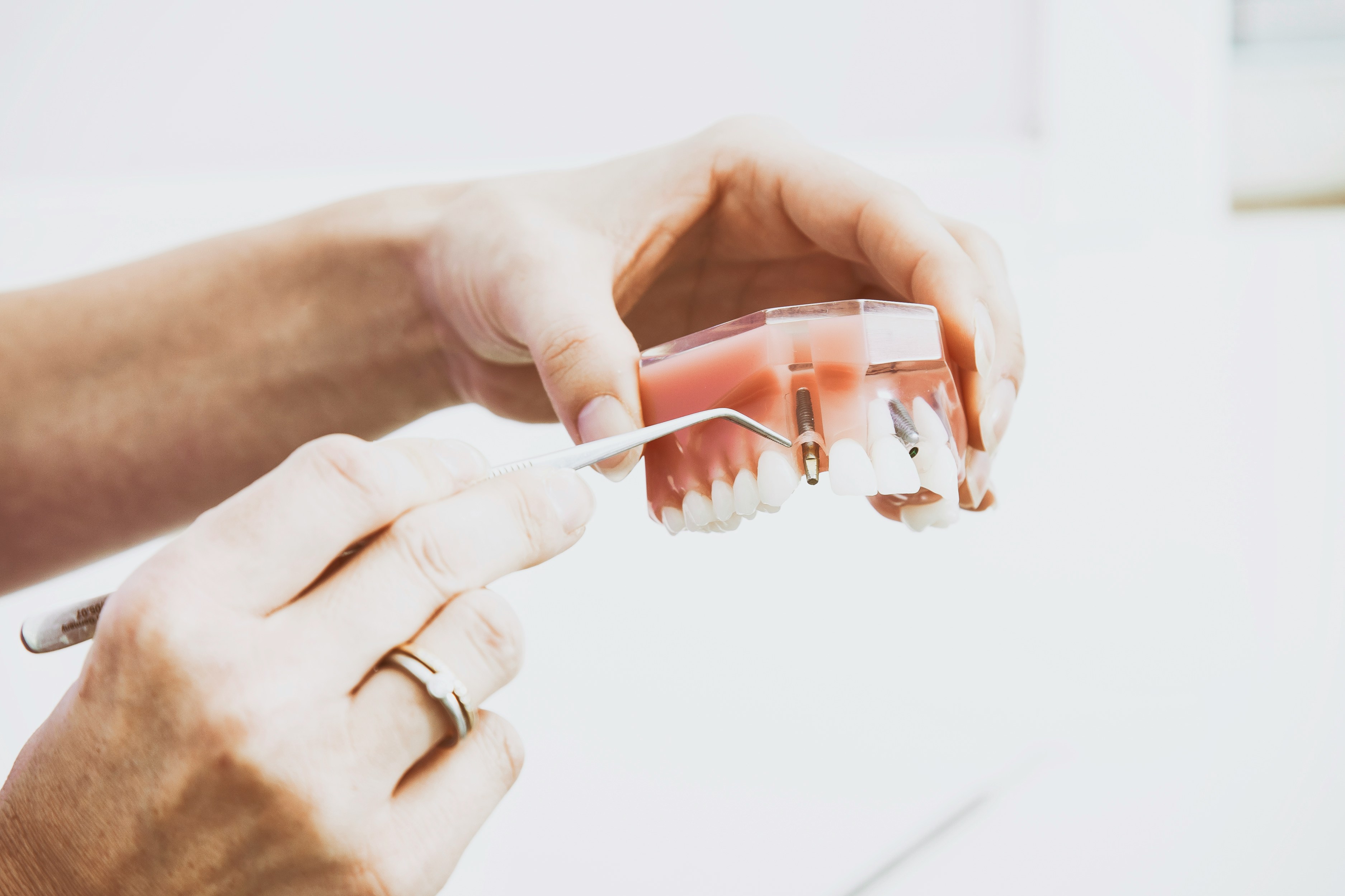 Dental implants and bridges