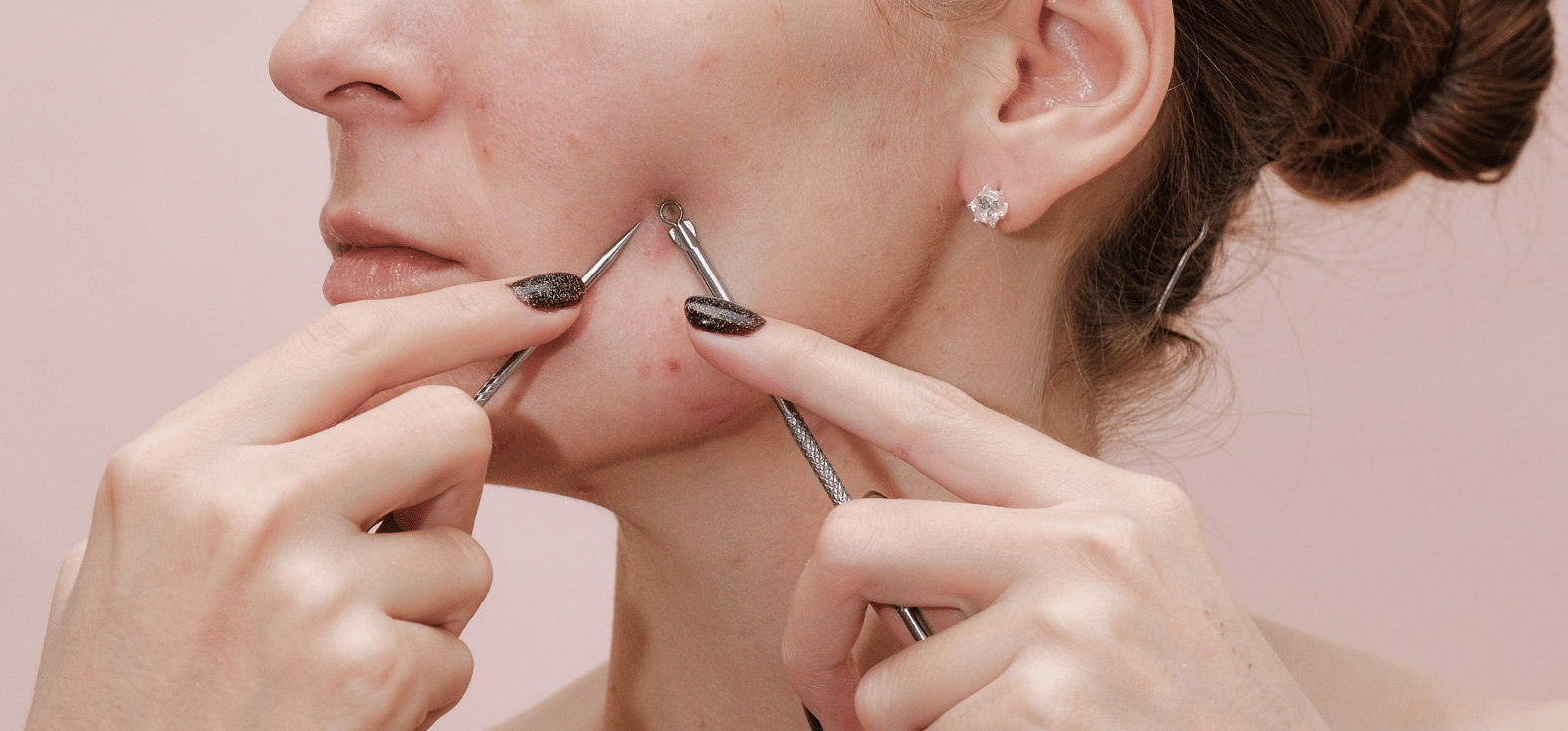 Women using Sofeel's Medical-grade blackhead removal needle on her acne.