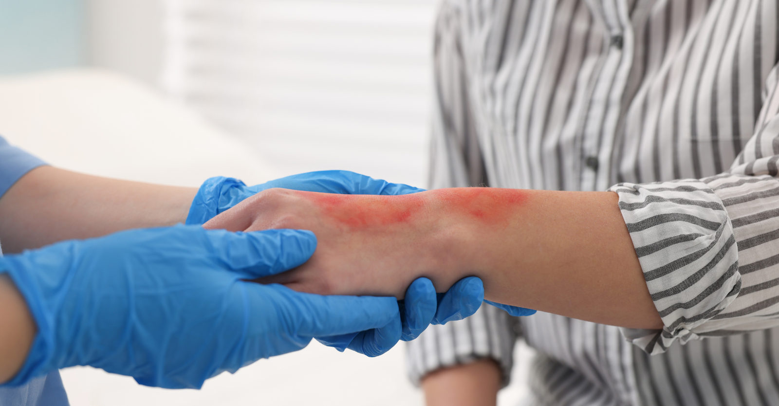 Burn Gels for Burn Treatment