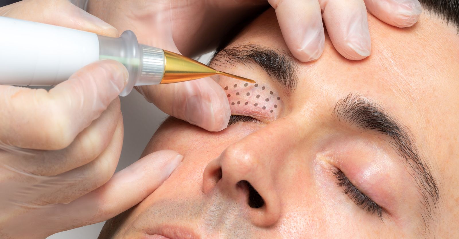Surgical Pens Skin Markings