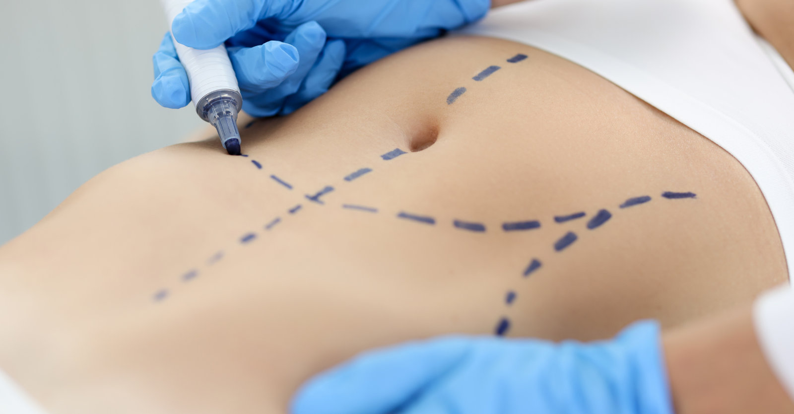 Surgical Skin Markers