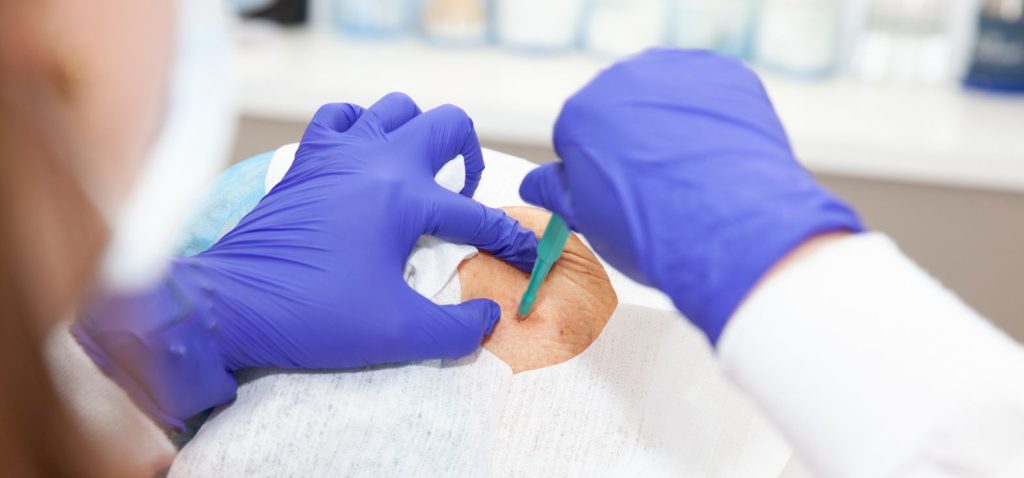 Biopsy Punches