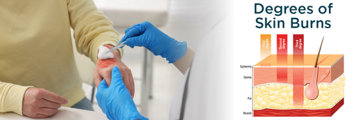 Understanding Second-Degree Burns