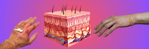 Understanding Burns: Impact on Skin Health and Recovery