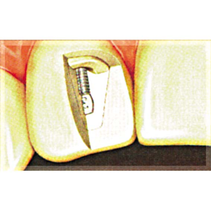 Op Po Precious Posts White 0.9mm 10/pk Pack