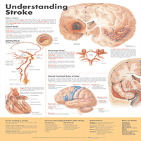 Chart, "Understanding Stroke", 51 x 66cm, Rigid, Each Each