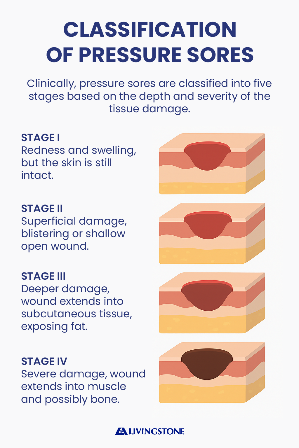 Classification of Pressure Sores