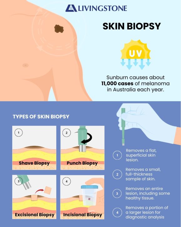 Skin Biopsy
